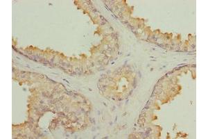 Immunohistochemistry of paraffin-embedded human prostate cancer using ABIN7145497 at dilution of 1:100 (GLB1L2 antibody  (AA 401-636))