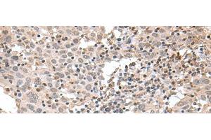 Immunohistochemistry of paraffin-embedded Human cervical cancer tissue using TDP2 Polyclonal Antibody at dilution of 1:75(x200) (TDP2 antibody)