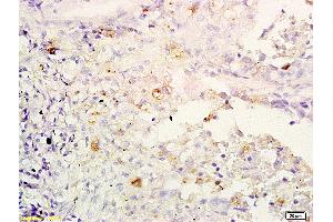 Formalin-fixed and paraffin embedded human lung carcinoma labeled with Anti-IL-32/NK4 Polyclonal Antibody, Unconjugated (ABIN748298) at 1:200 followed by conjugation to the secondary antibody and DAB staining
