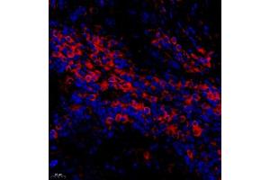 Immunofluorescence of paraffin embedded human cervical cancer using BTBD6 (ABIN7073235) at dilution of 1:50 (400x lens) (BTBD6 antibody)