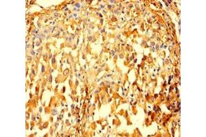 Immunohistochemistry of paraffin-embedded human lung cancer using ABIN7156292 at dilution of 1:100 (IMPDH2 antibody  (AA 5-514))