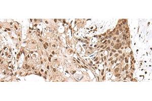 Immunohistochemistry of paraffin-embedded Human esophagus cancer tissue using MAGOHB Polyclonal Antibody at dilution of 1:70(x200) (Mago Nashi Homolog 2 antibody)