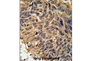 FBXL2 Antibody (C-term) (ABIN651220 and ABIN2840138) IHC analysis in formalin fixed and paraffin embedded human lung carcinoma followed by peroxidase conjugation of the secondary antibody and DAB staining. (FBXL2 antibody  (C-Term))