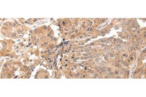Immunohistochemistry of paraffin-embedded Human breast cancer tissue using CLDND2 Polyclonal Antibody at dilution 1:45 (CLDND2 antibody)