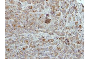 IHC-P Image Immunohistochemical analysis of paraffin-embedded MCF7 xenograft, using ULK2, antibody at 1:500 dilution. (ULK2 antibody  (C-Term))