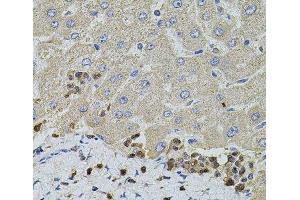 Immunohistochemistry of paraffin-embedded Human liver damage using S100A12 Polyclonal Antibody at dilution of 1:100 (40x lens). (S100A12 antibody)
