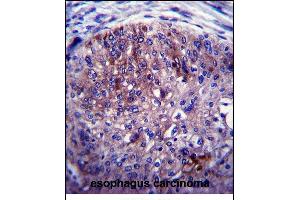ADAL Antibody (C-term) (ABIN657544 and ABIN2846559) immunohistochemistry analysis in formalin fixed and paraffin embedded human esophagus carcinoma followed by peroxidase conjugation of the secondary antibody and DAB staining. (ADAL antibody  (C-Term))