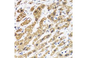 Immunohistochemistry of paraffin-embedded human liver cancer using HAPLN1 antibody. (HAPLN1 antibody  (AA 165-354))
