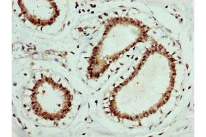 IHC image of ABIN7152021 diluted at 1:400 and staining in paraffin-embedded human breast cancer performed on a Leica BondTM system. (EPOR antibody  (AA 320-506))