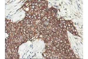 Immunohistochemical staining of paraffin-embedded Adenocarcinoma of Human breast tissue using anti-PFKP mouse monoclonal antibody. (PFKP antibody)