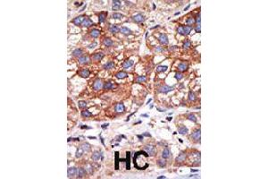 Formalin-fixed and paraffin-embedded human hepatocellular carcinoma tissue reacted with YY1 polyclonal antibody  , which was peroxidase-conjugated to the secondary antibody, followed by DAB staining . (YY1 antibody  (N-Term))