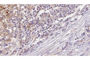ABIN6272656 at 1/100 staining Human liver cancer tissue by IHC-P. (DNER antibody  (Internal Region))