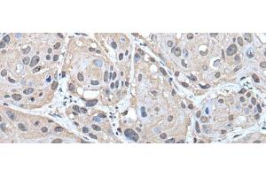 Immunohistochemistry of paraffin-embedded Human esophagus cancer tissue using HELLS Polyclonal Antibody at dilution of 1:30(x200) (HELLS antibody)