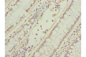 Immunohistochemistry of paraffin-embedded human colon cancer using ABIN7165317 at dilution of 1:100 (EFR3B antibody  (AA 1-298))