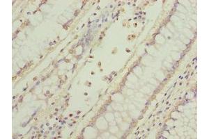 Immunohistochemistry of paraffin-embedded human colon cancer using ABIN7165317 at dilution of 1:100