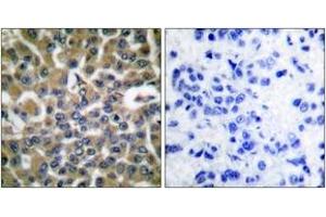 Immunohistochemistry analysis of paraffin-embedded human breast carcinoma tissue, using eEF2 (Ab-56) Antibody. (EEF2 antibody  (AA 31-80))