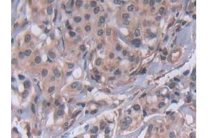 Detection of MMP23B in Human Breast cancer Tissue using Polyclonal Antibody to Matrix Metalloproteinase 23B (MMP23B) (MMP23B antibody  (AA 79-390))