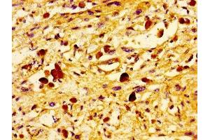 Immunohistochemistry of paraffin-embedded human melanoma using ABIN7174438 at dilution of 1:100 (UBE2D2 antibody  (AA 1-147))