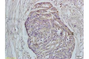 Formalin-fixed and paraffin embedded human rectal carcinoma tissue labeled with Rabbit Anti-GPR30 Polyclonal Antibody (ABIN685717) at 1:200 followed by conjugation to the secondary antibody and DAB staining. (GPER antibody  (AA 251-375))