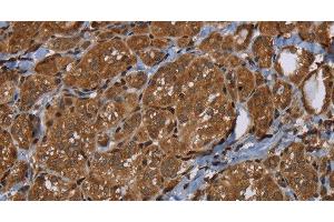 Immunohistochemistry of paraffin-embedded Human thyroid cancer using HSD17B4 Polyclonal Antibody at dilution of 1:30