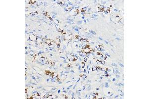 Immunohistochemistry of paraffin-embedded Human oophoroma using BOL Rabbit pAb (ABIN7265891) at dilution of 1:50 (40x lens). (BOLA3 antibody  (AA 1-68))