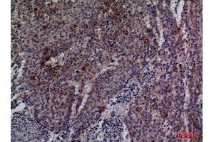 Immunohistochemistry (IHC) analysis of paraffin-embedded Human Lung Cancer, antibody was diluted at 1:100.