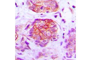 Immunohistochemical analysis of GPR160 staining in human breast cancer formalin fixed paraffin embedded tissue section. (GPR160 antibody  (C-Term))
