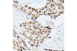 Immunohistochemistry of paraffin-embedded human breast cancer using KIF22 antibody  at dilution of 1:100 (40x lens). (KIF22 antibody  (AA 456-665))