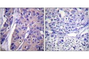 Immunohistochemistry analysis of paraffin-embedded human breast carcinoma, using C-RAF (Phospho-Ser296) Antibody.