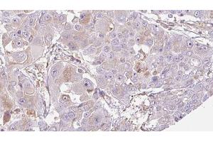 ABIN6272705 at 1/100 staining Human liver cancer tissue by IHC-P.