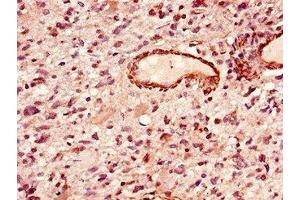 Immunohistochemistry of paraffin-embedded human glioma using ABIN7155905 at dilution of 1:100 (LIPE antibody  (AA 1-251))