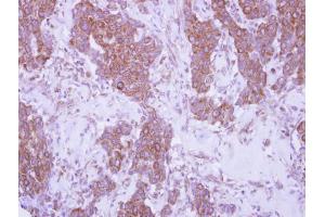 IHC-P Image Immunohistochemical analysis of paraffin-embedded human breast cancer, using CD79b, antibody at 1:250 dilution. (CD79b antibody  (Center))