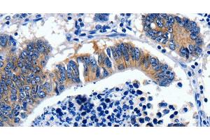 Immunohistochemistry of paraffin-embedded Human colon cancer tissue using GAD2 Polyclonal Antibody at dilution 1:30 (GAD65 antibody)