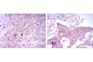 Immunohistochemical analysis of paraffin-embedded lung cancer tissues (left) and ovarian cancer tissues (right) using FOXD3 mouse mAb with DAB staining. (FOXD3 antibody)