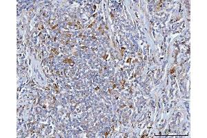 IHC analysis of BCAT1 using anti-BCAT1 antibody (ABIN7602594). (BCAT1 antibody  (AA 88-386))