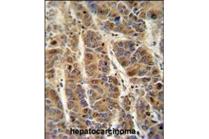 C4BPA antibody immunohistochemistry analysis in formalin fixed and paraffin embedded human hepatocarcinoma followed by peroxidase conjugation of the secondary antibody and DAB staining.