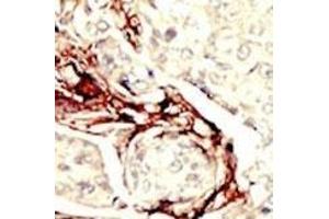 Formalin-fixed and paraffin-embedded human cancer tissue reacted with the primary antibody, which was peroxidase-conjugated to the secondary antibody, followed by DAB staining.
