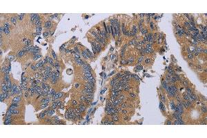 Immunohistochemistry of paraffin-embedded Human colon cancer using PRKD3 Polyclonal Antibody at dilution of 1:50 (PRKD3 antibody)