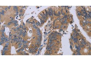 Immunohistochemistry of paraffin-embedded Human colon cancer using PRKD3 Polyclonal Antibody at dilution of 1:50