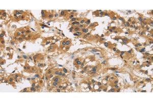 Immunohistochemistry of paraffin-embedded Human thyroid cancer using GAS7 Polyclonal Antibody at dilution of 1:50 (GAS7 antibody)