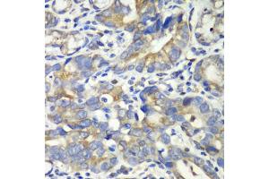 Immunohistochemistry of paraffin-embedded human gastric cancer using ABAT antibody (ABIN1876487) at dilution of 1:100 (40x lens). (ABAT antibody)
