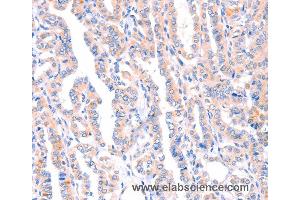 Immunohistochemistry of Human thyroid cancer using AMPD1 Polyclonal Antibody at dilution of 1:70