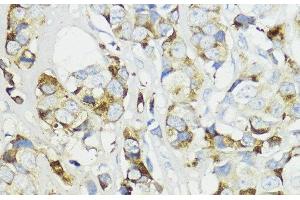 Immunohistochemistry of paraffin-embedded Human mammary cancer using Complement Factor B Polyclonal Antibody at dilution of 1:200 (40x lens). (Complement Factor B antibody)