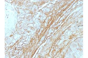Formalin-fixed, paraffin-embedded human Lung Carcinoma stained with Tenascin C Monoclonal Antibody (T2H5). (TNC antibody)