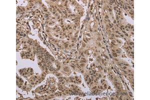 Immunohistochemistry of Human gastric cancer using CAB39 Polyclonal Antibody at dilution of 1:50