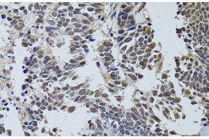 Immunohistochemistry of paraffin-embedded Human lung cancer using LKB1 Polyclonal Antibody at dilution of 1:100 (40x lens). (LKB1 antibody)