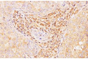 Immunohistochemistry of paraffin-embedded Human breast cancer using Il2 Polyclonal Antibody at dilution of 1:100 (IL-2 antibody)