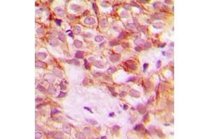Immunohistochemical analysis of Collagen 1 alpha 2 staining in human breast cancer formalin fixed paraffin embedded tissue section.