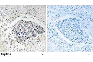 Immunohistochemistry analysis of paraffin-embedded human lung carcinoma tissue using CPNE8 polyclonal antibody . (CPNE8 antibody)