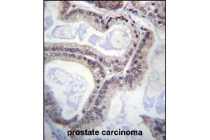 EIF1AY Antibody (N-term) (ABIN657081 and ABIN2846242) immunohistochemistry analysis in formalin fixed and paraffin embedded human prostate carcinoma followed by peroxidase conjugation of the secondary antibody and DAB staining. (EIF1AY antibody  (N-Term))